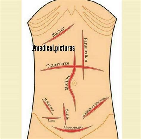 Types Of Surgical Incisions Medical Anatomy Emergency Medical Medical