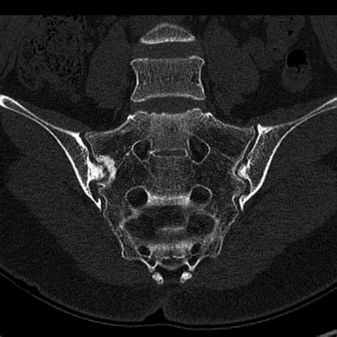 Computed Tomography Ct Of The Pelvic Bone Ct Showed An Accessory
