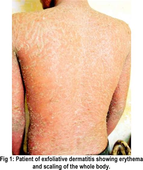 Figure 1 From Exfoliative Dermatitis A Clinico Etiological Study