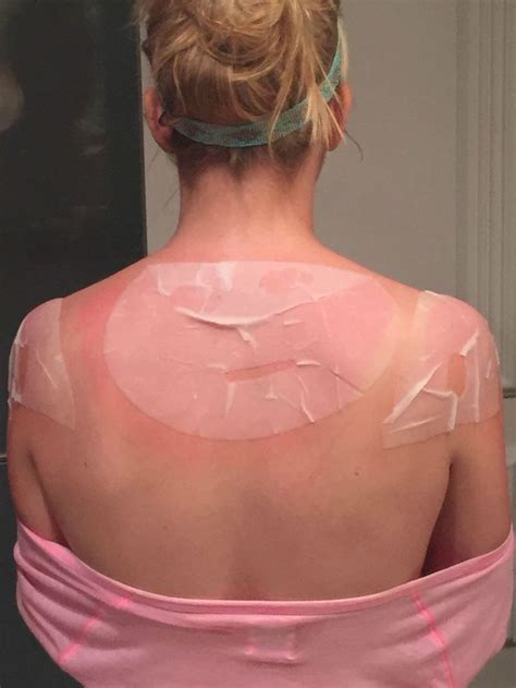 8 Best Sunburns Images On Pinterest Searching Worst Sunburn And Bad