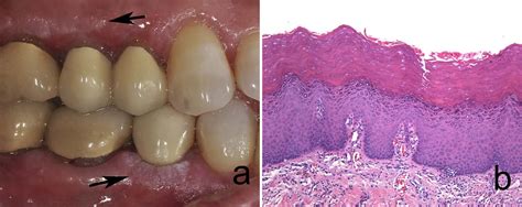 Oral Epithelial Dysplasia Atypical Verrucous Lesions And Oral