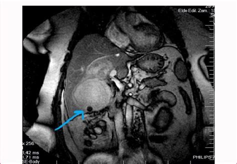 Axial T2 Weighted Fat Suppressed Mr Image Shows Multiloculated