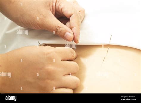 Applying Acupuncture On Skin Stock Photo Alamy