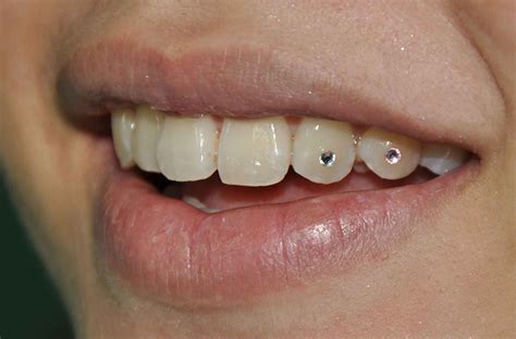 How can you make your own tooth filling at home? Diamond Tooth Implant Dental jewellery | Bling Bling ...