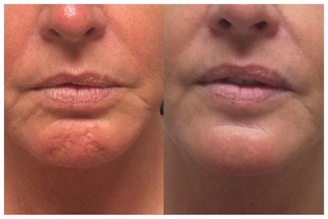 My Client Loves The New And Improved Appearance Of Her Chin Botox Is A Great Way To Relax Lines