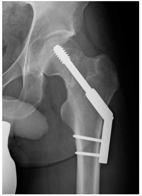 Jcm Free Full Text A Comparison Of Dynamic Hip Screw And Two