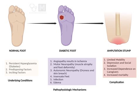 Diabetic Foot Ulcer Stages A Concise Guide My Endo Consult
