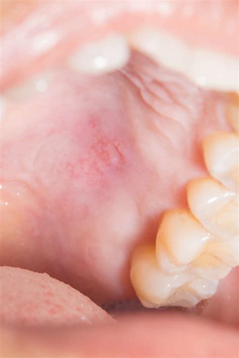 Bump On The Roof Of The Mouth 12 Causes