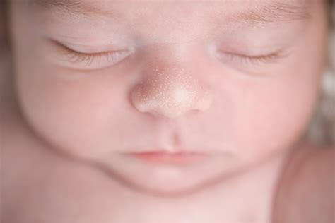 Milia In Newborn Babies Causes Types Symptoms And Treatment