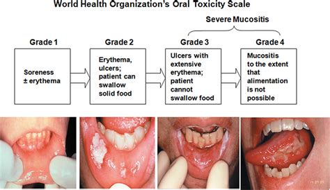 Oral Mucositis Definition Causes Symptoms Treatment Guidelines