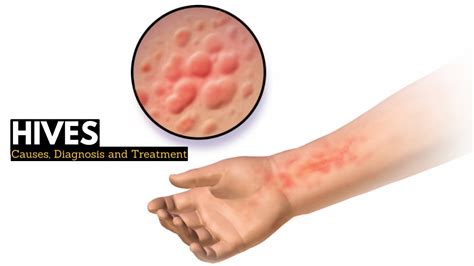 Hives Causes Signs And Symptoms Diagnosis And Treatment Youtube