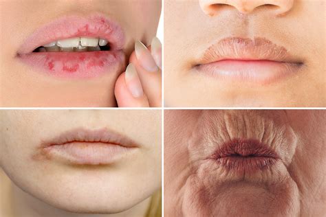 The 8 Warning Signs Your Lips Reveal About Your Health From Herpes To