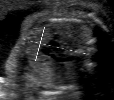 Ultrasound Image Of The Transverse Diameter Of The Fetal Thymus With A