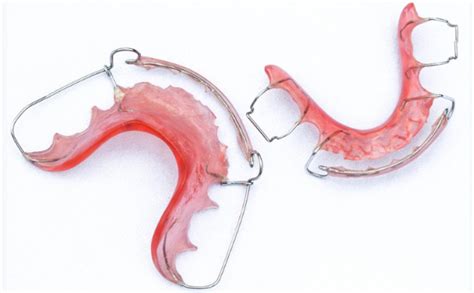 Berdasarkan ketebalan dan fleksibilitasnya, gigi palsu lepasan plat flexible terdiri dari 3 tipe, yaitu lucitone, bioton, dan valplast. Pakai retainer dan gigi palsu