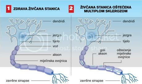 Scleroza multipla (scleroza in placi sau encefalomielita diseminata) este o afectiune neurologica ce apare la adultul tanar, intre 20 si 40 de ani ce afecteaza nervii optici, maduva spinarii si creierul. Multipla skleroza: Šta je multipla skleroza?