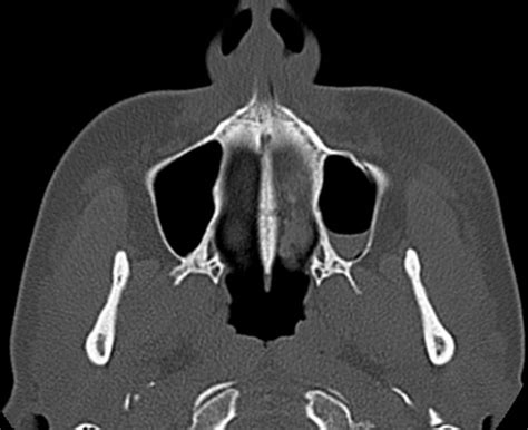 Maxillary Sinus Wall Fracture