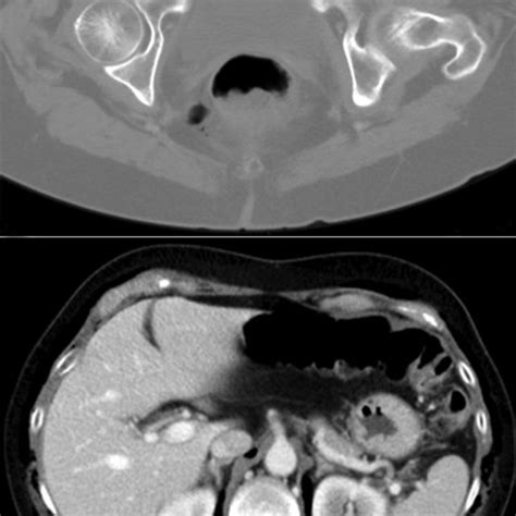A Abdominal Ct Scan Showing Subcutaneous Emphysema And Download