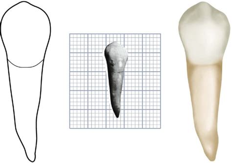 10 The Permanent Mandibular Premolars Pocket Dentistry
