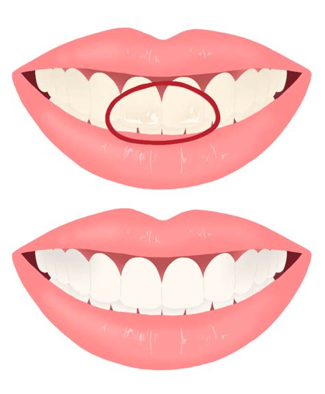 Remove White Spots On Teeth Treatment With Free Tips