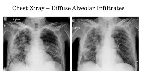 Diffuse Alveolar Hemorrhage X Ray