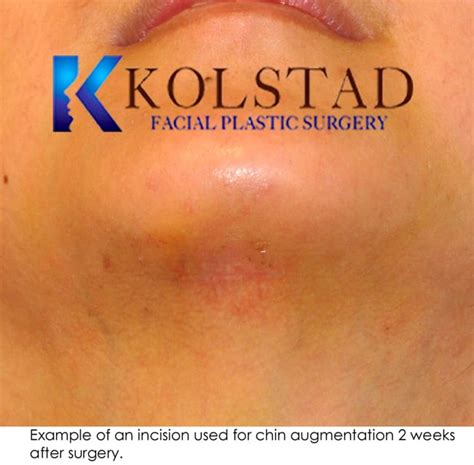 Chin Augmentation Before And After Gallery Dr Kolstad San Diego