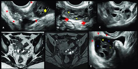 A Axial Oblique Transvaginal Ultrasound Tvus Image Shows A Large