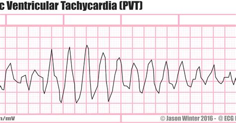 Ecg Educator Blog Polymorphic Ventricular Tachycardia Pvt