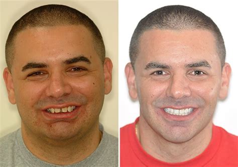 Case 7 Lower Jaw Surgery And Genioplasty Sydney Oral And Facial Surgery