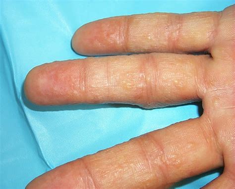 Drfebritilova Dermatitis Dishidrosispompholyx