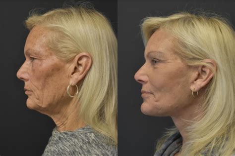 Facelift & Neck Lift Before & After Photos Patient 23 ...