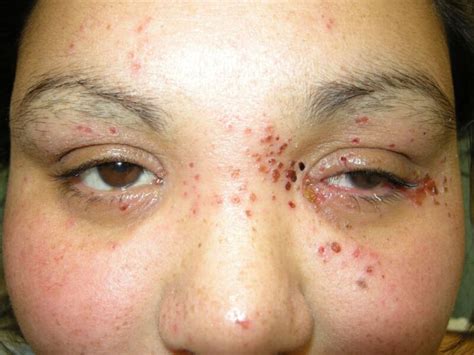 Figure Eczema Herpeticum Dermnet New Zealand Statpearls Ncbi