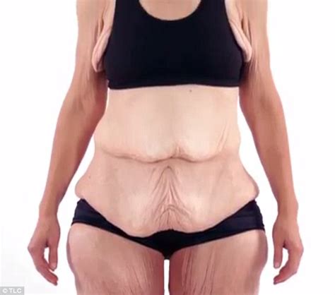 Woman Needs Surgery To Remove Excess Skin To Save Marriage Daily Mail