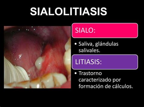 Signs And Symptoms Sialolithiasis