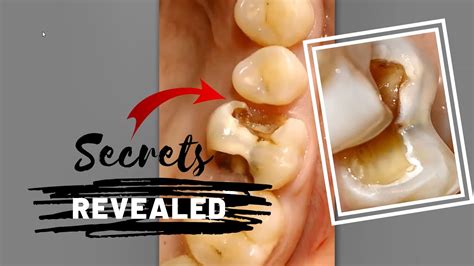 Secrets Of Caries Excavation Revealed Dentistry Youtube