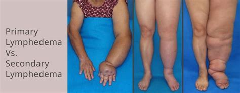 Pin On Lymphedema Education