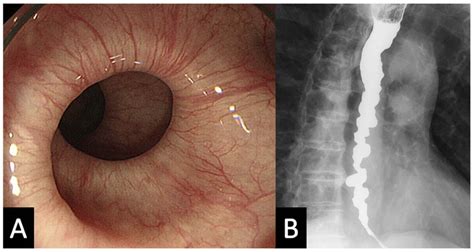 Diffuse Esophageal Spasm Corkscrew Esophagus The American Journal Of Medicine