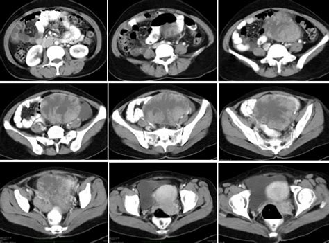 Ovarian Serous Cystadenocarcinoma Radiology Cases