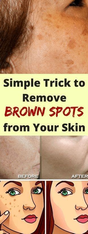 simple trick to remove brown spots from your skin brown spots on skin spots on face brown