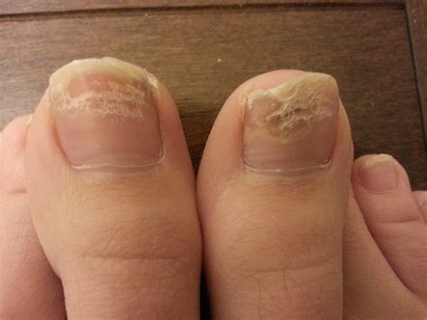 What Is Wrong With My Toenail Beds Rhealth