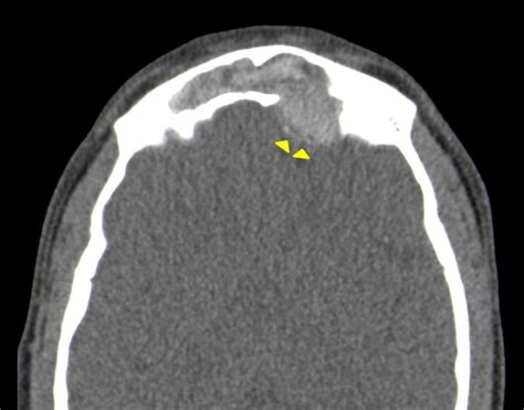 March 19 2020 Case Of The Week American Journal Of Neuroradiology