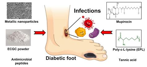 Types Of Dressing In Diabetic Wound Things Column Image Library