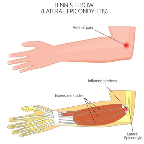 Tennis Elbow Lateral Epicondylitis Elbow Specialist South Windsor