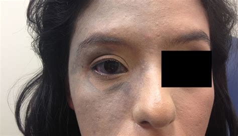 Derm Dx Blue Mark On The Face And Eye Clinical Advisor