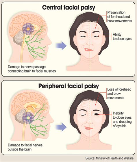 Viral Infection May Cause Facial Palsy The Korea Times