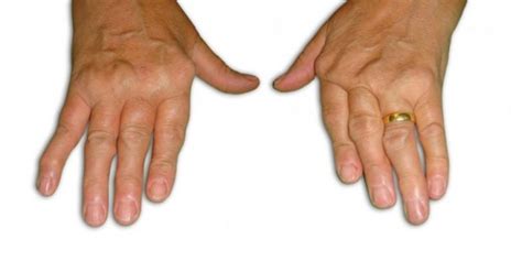Arthrite Rhumatoïde Hand Surgeryeu