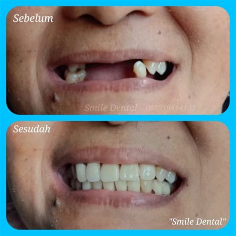gigi palsu valplast arsip smile dental ahli gigi palsu smile dental ahli gigi palsu