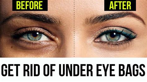 How To Get Rid Of Bags Under Eyes Under Eye Wrinkles Undereye Baggy Eyes