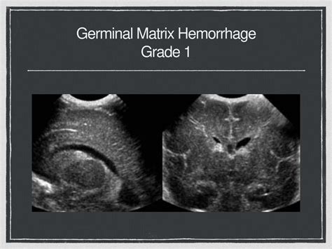 Germinal Matrix Hemorrhage Grade 1