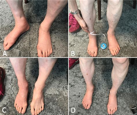Subsiding Of Dependent Oedema Asymmetric Pitting Oedema Was Observed