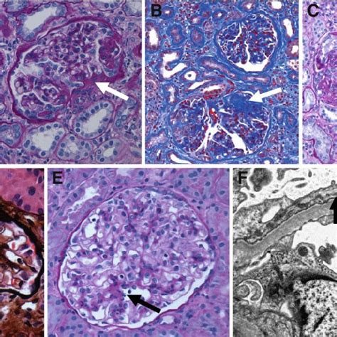 Renal Biopsies Of Native Kidney And Renal Allograft Showing Focal